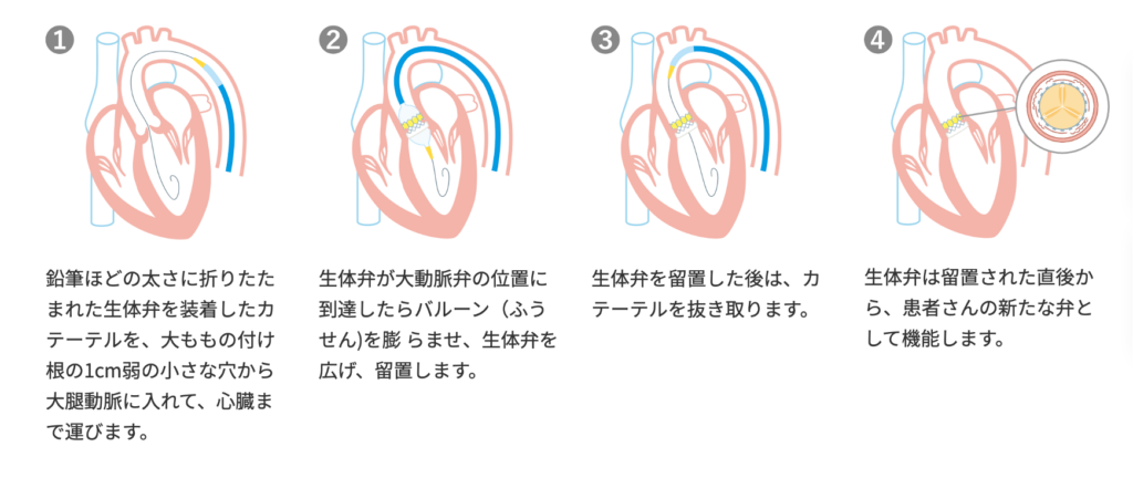 大動脈弁狭窄症に対するカテーテル治療の概要