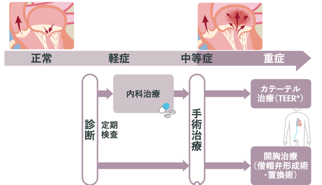 僧帽弁閉鎖不全症の治療計画