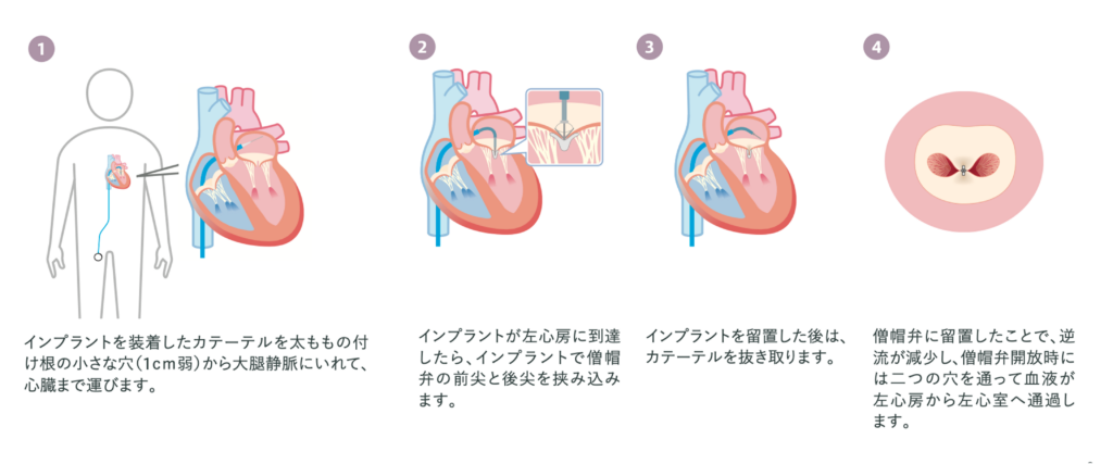 僧帽弁閉鎖不全症に対するカテーテル治療の概要