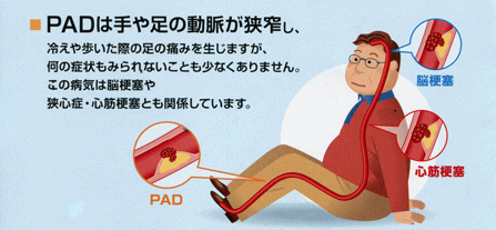 PADは手や脚の動脈が狭窄し、冷えや歩いた際の足の痛みを生じますが、何の症状も見られないことも少なくありません。この病気は脳梗塞や狭心症・心筋梗塞とも関係しています。