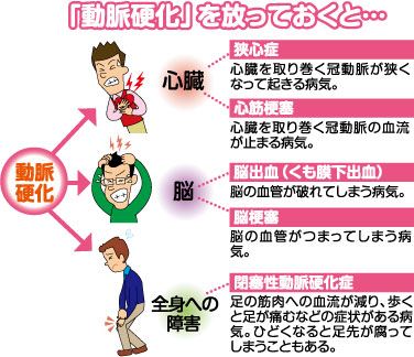 動脈硬化を放っておくと　狭心症・心筋梗塞・脳出血（くも膜下出血）・脳梗塞・閉塞性動脈硬化症になります。