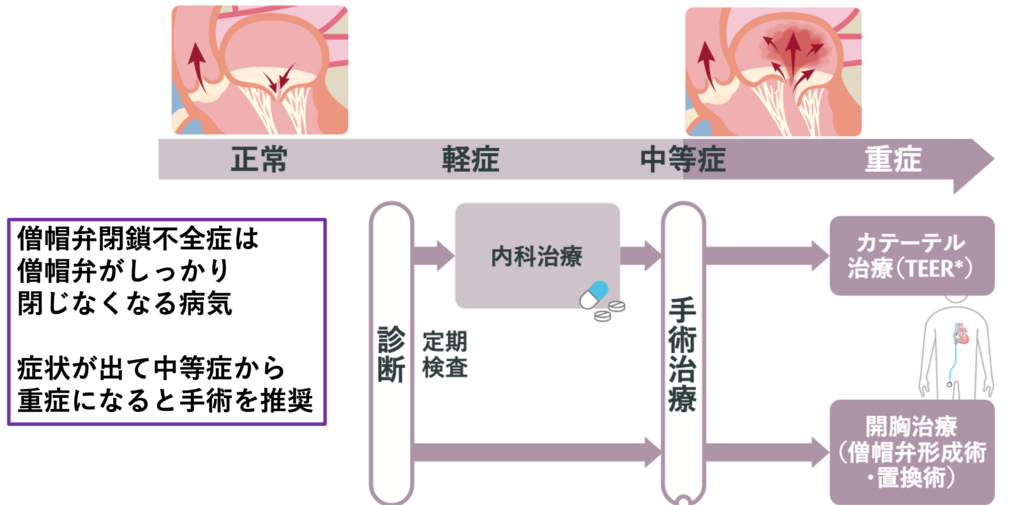 僧帽弁閉鎖不全症の治療計画